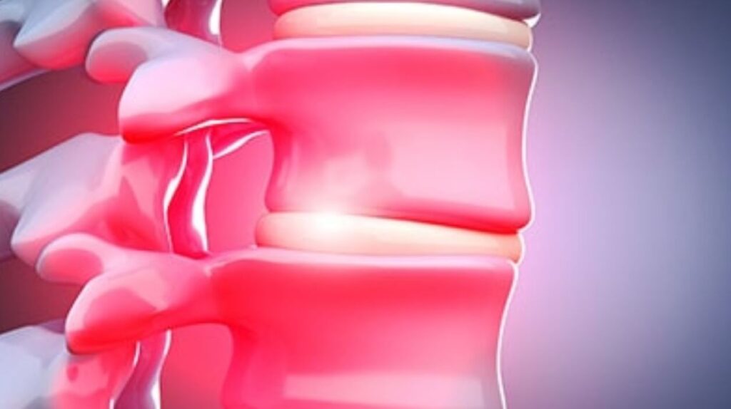 Can Foraminal Stenosis Be Caused by Auto Accident