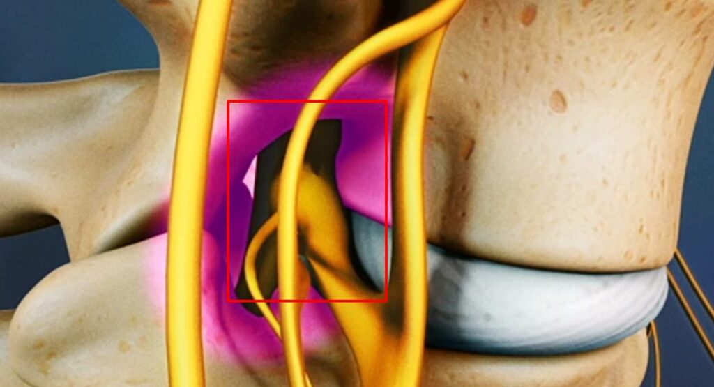 Is Spinal Stenosis a Permanent Injury